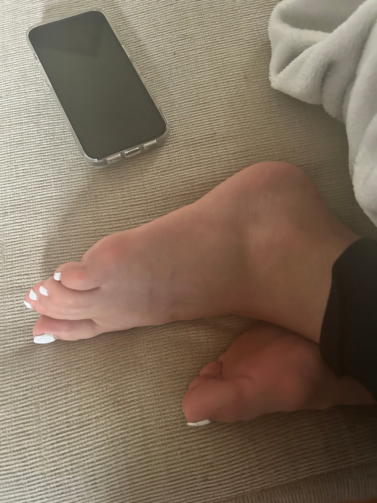 Bunions