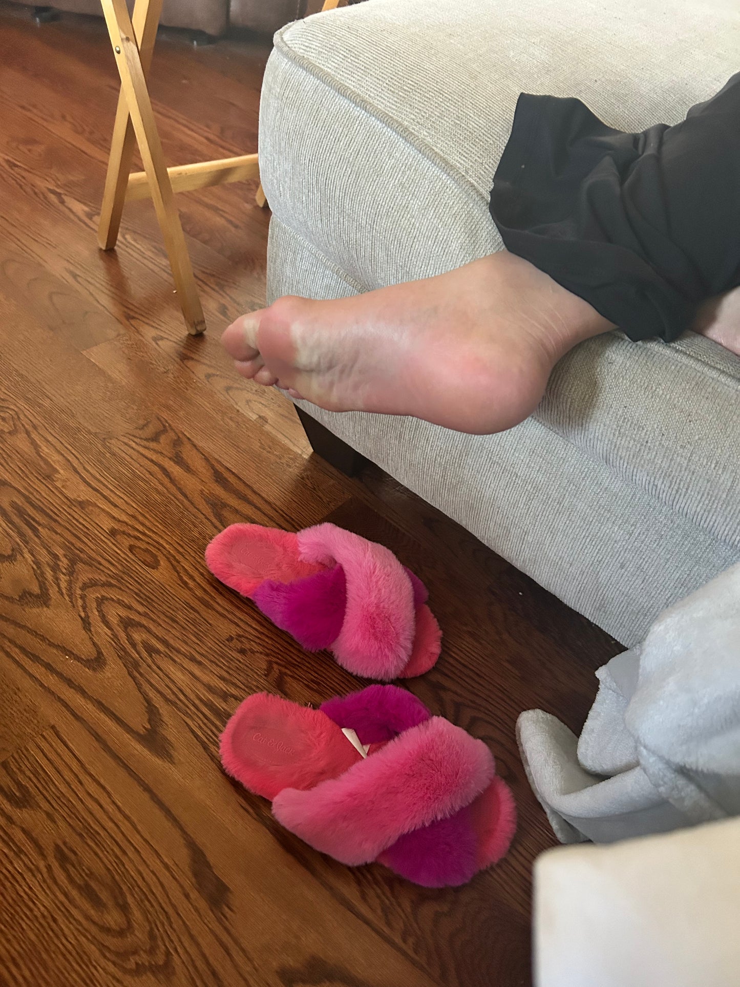 Bunions