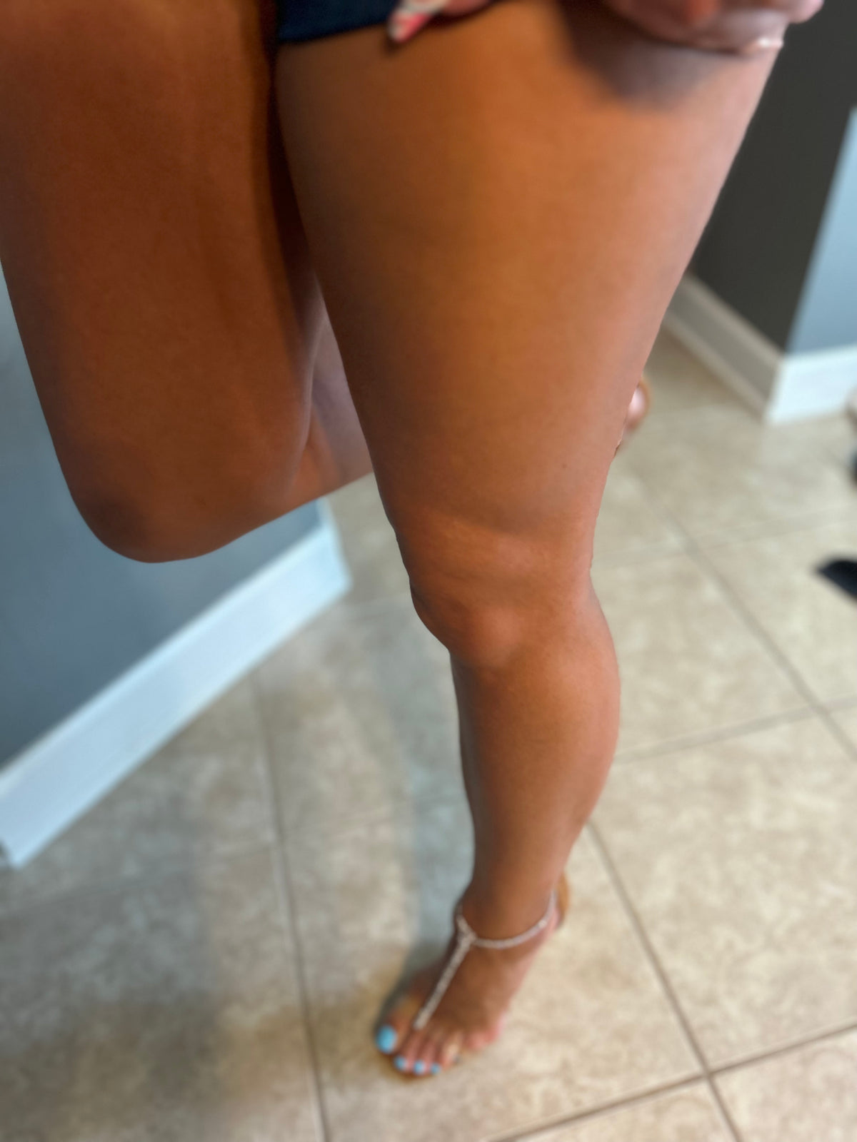 Bunions