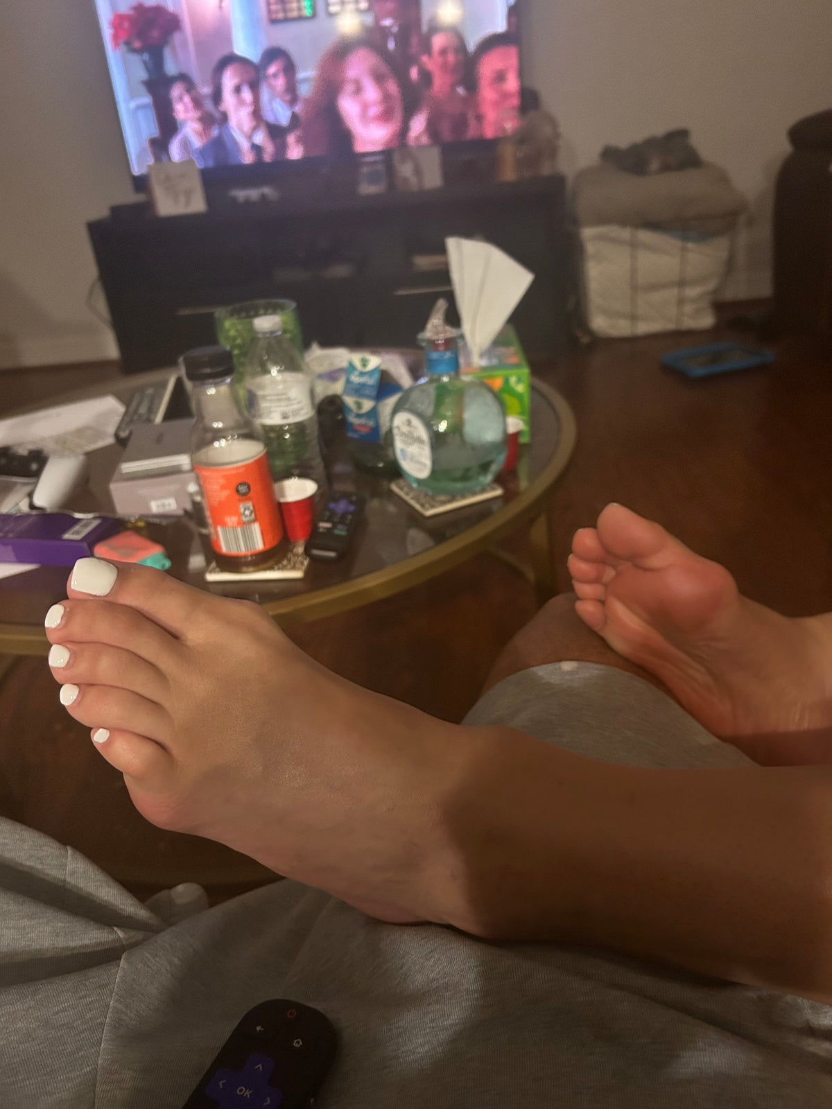 Bunions