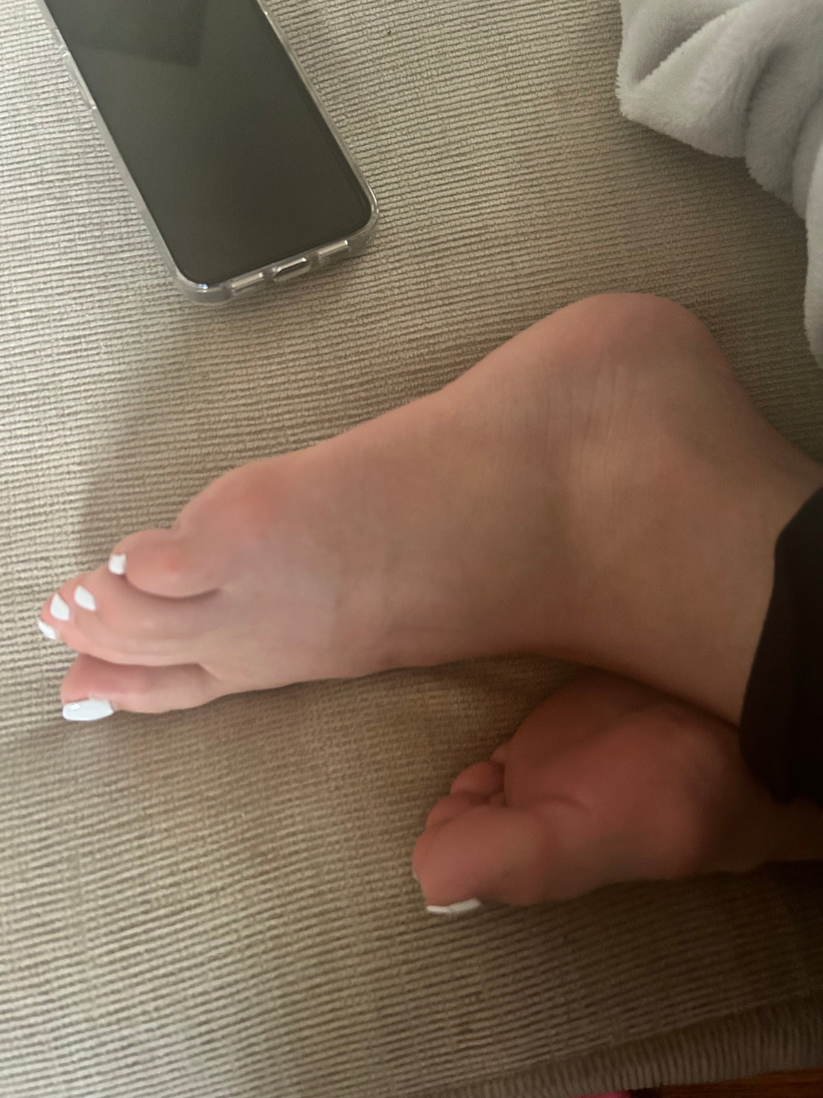Bunions