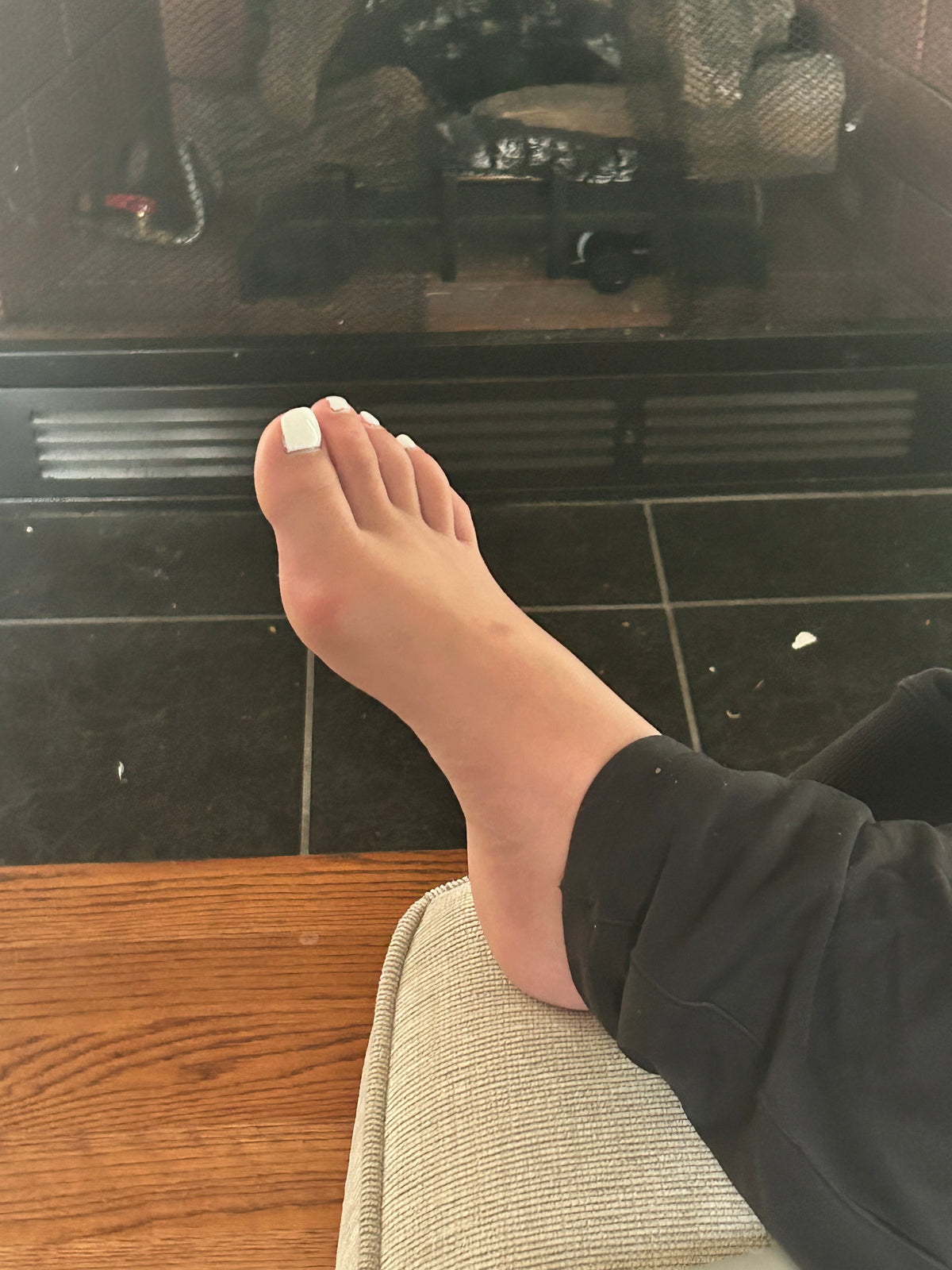 Bunions