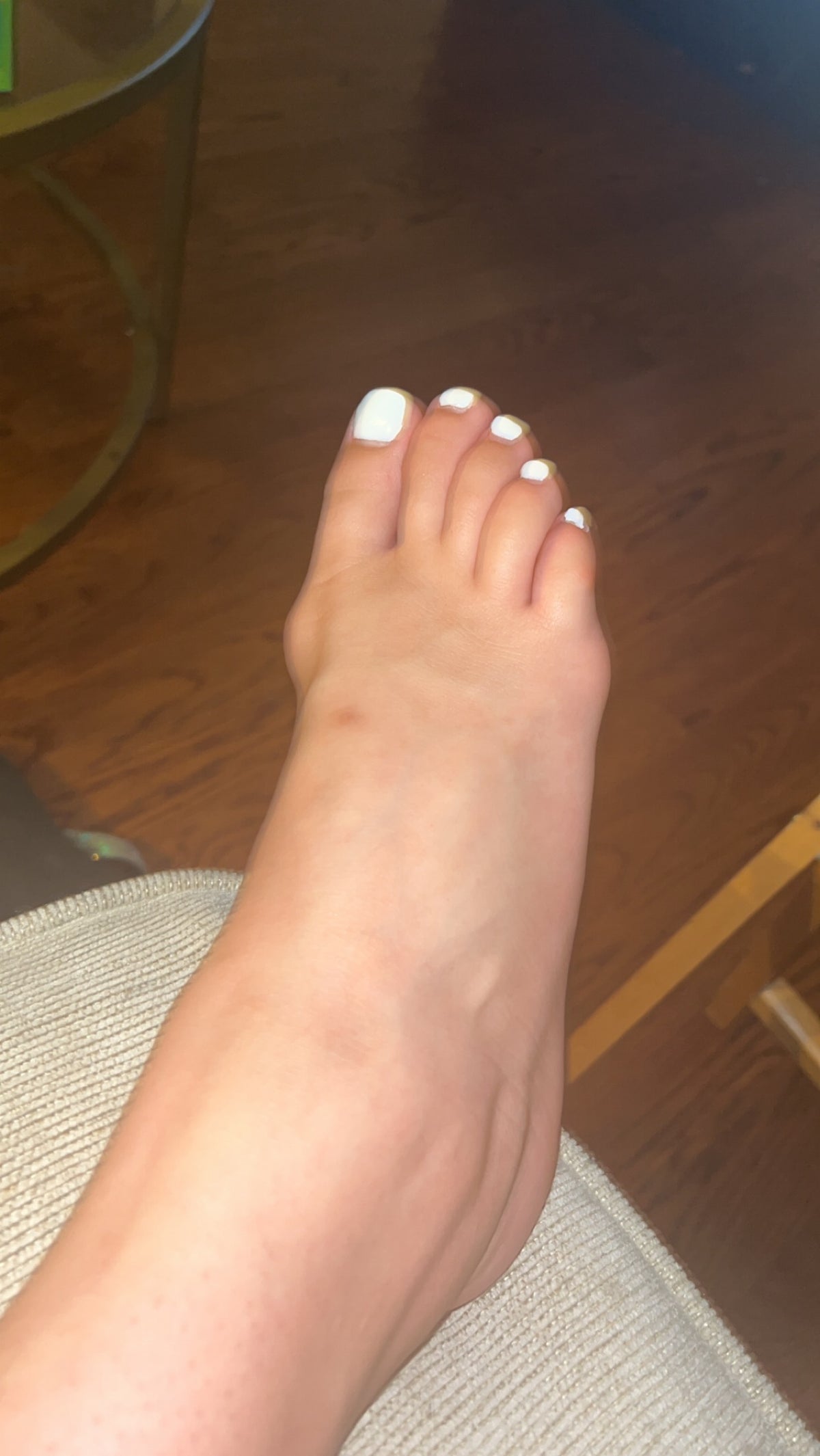 Bunions