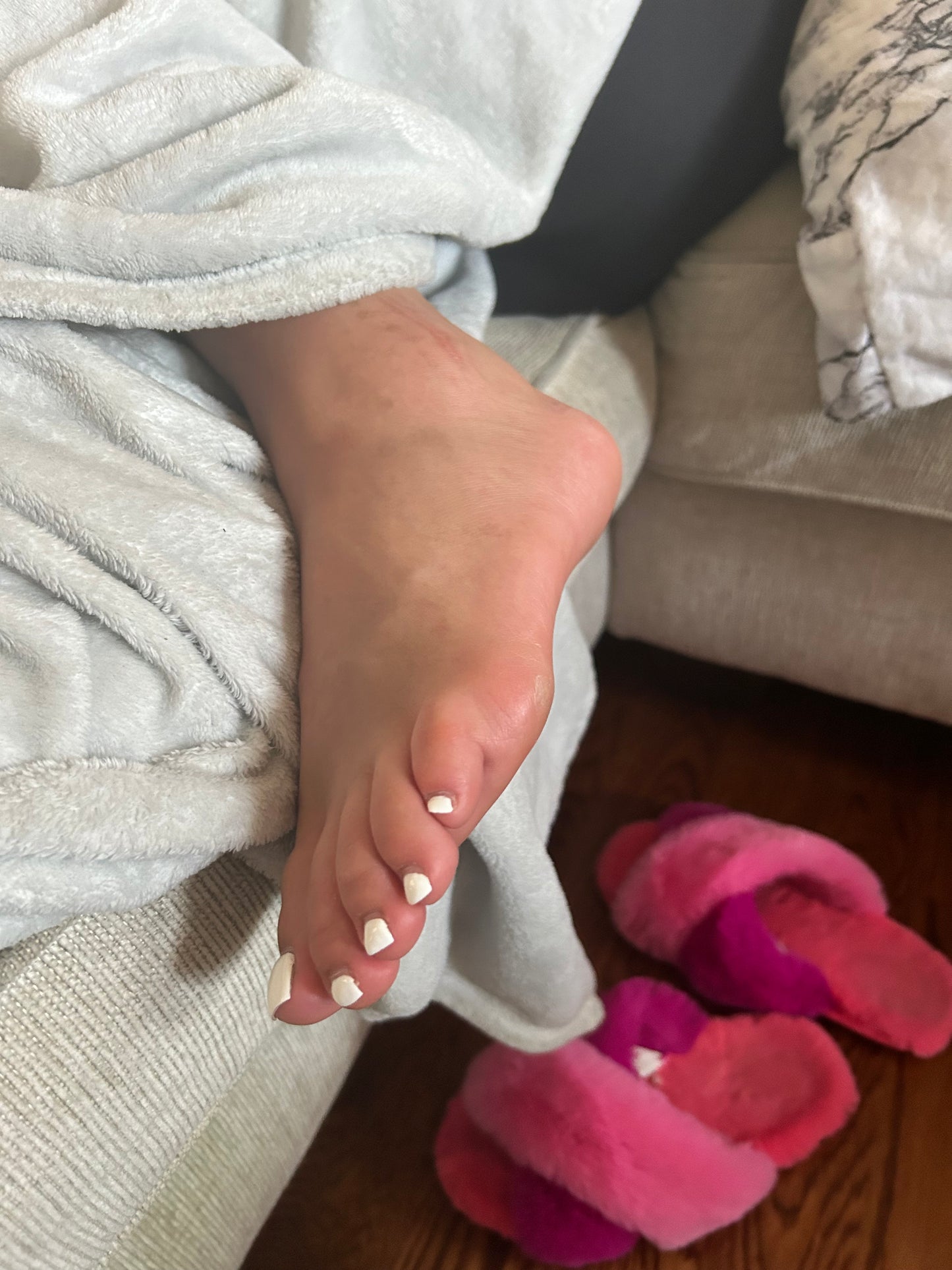 Bunions