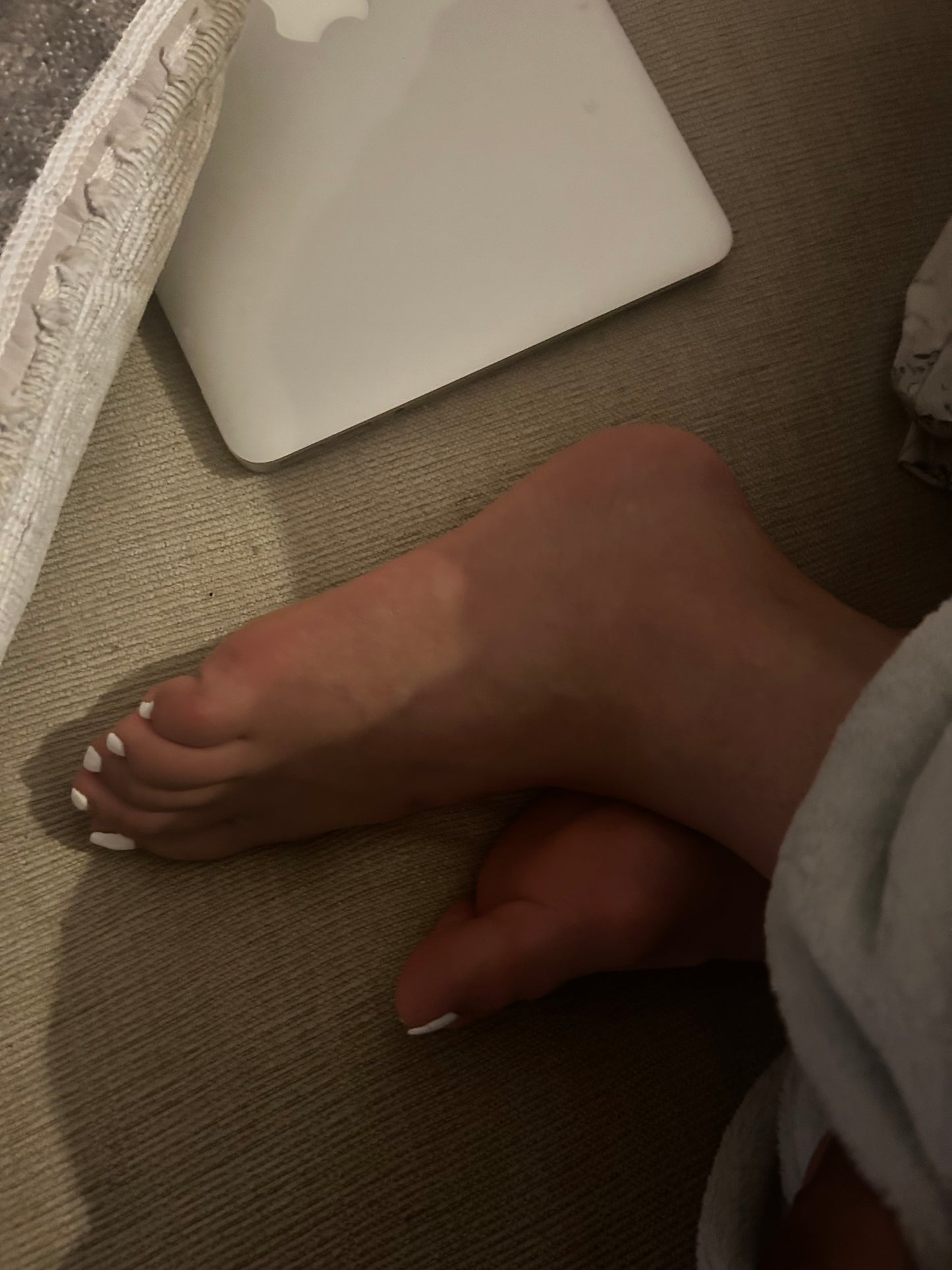 Bunions