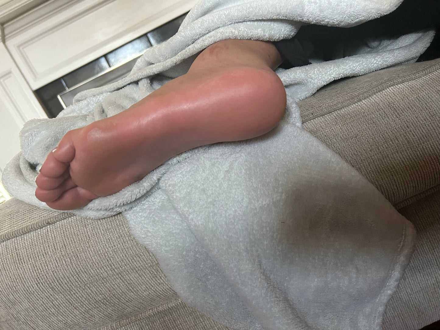 Bunions
