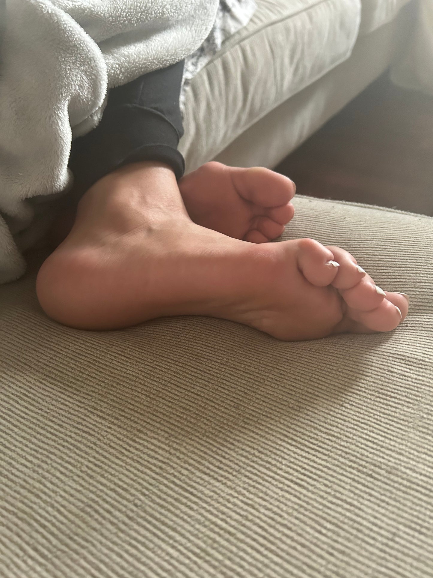 Bunions