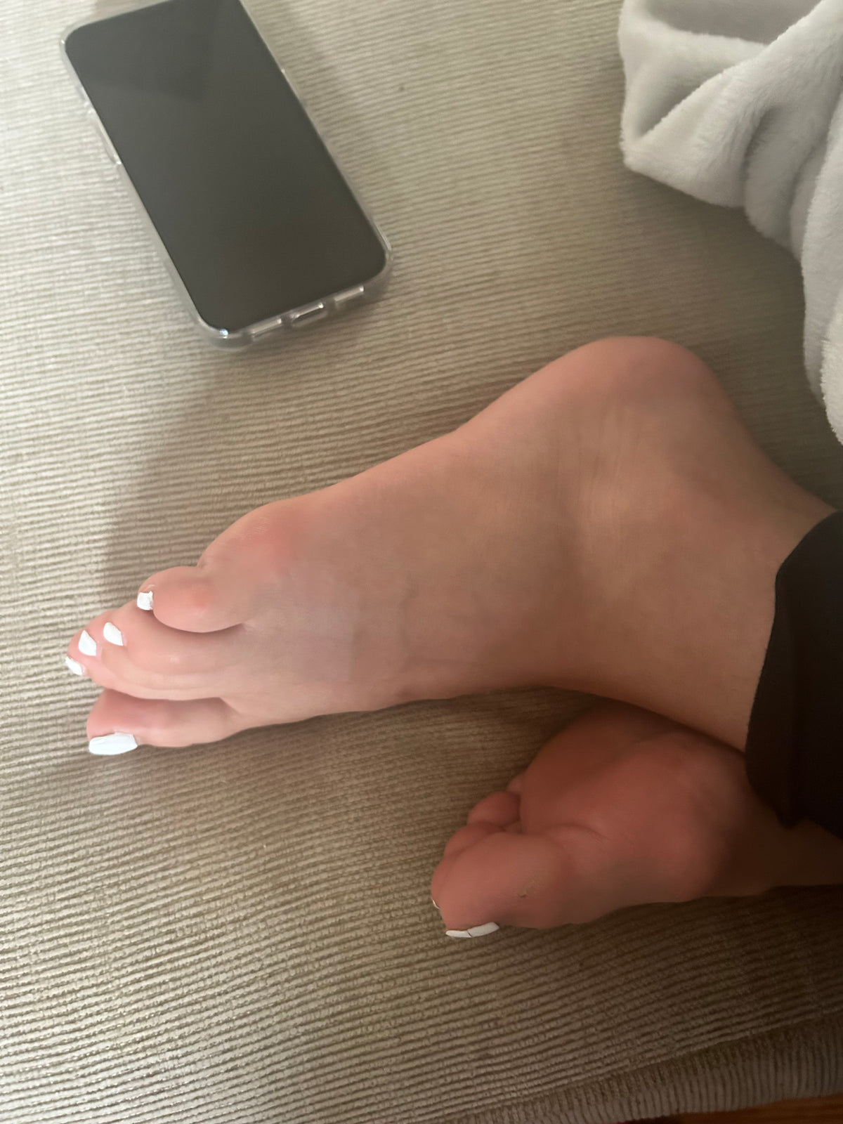 Bunions