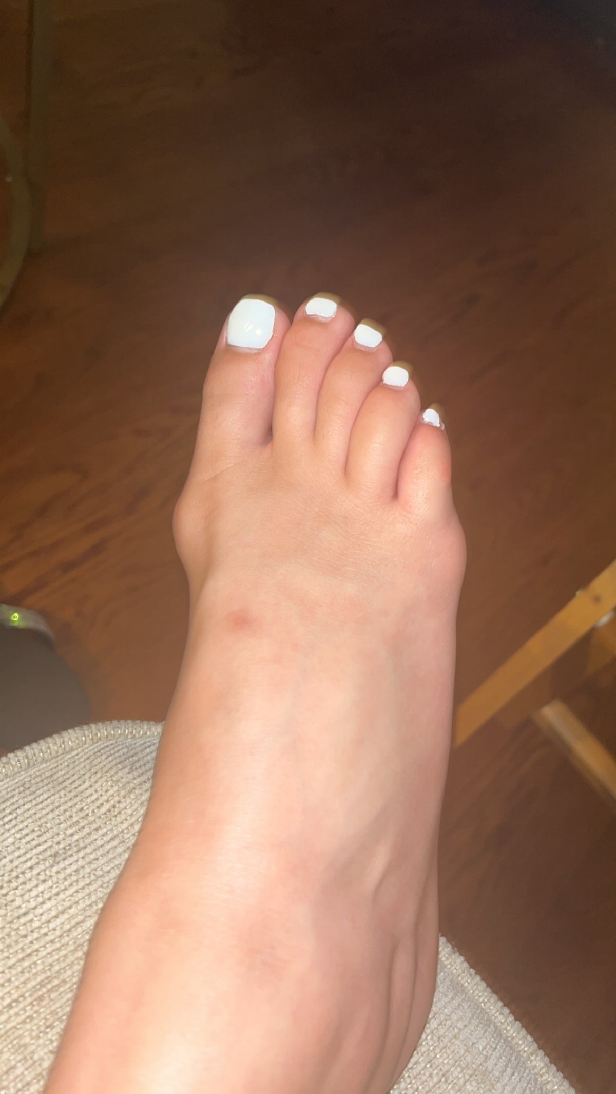 Bunions