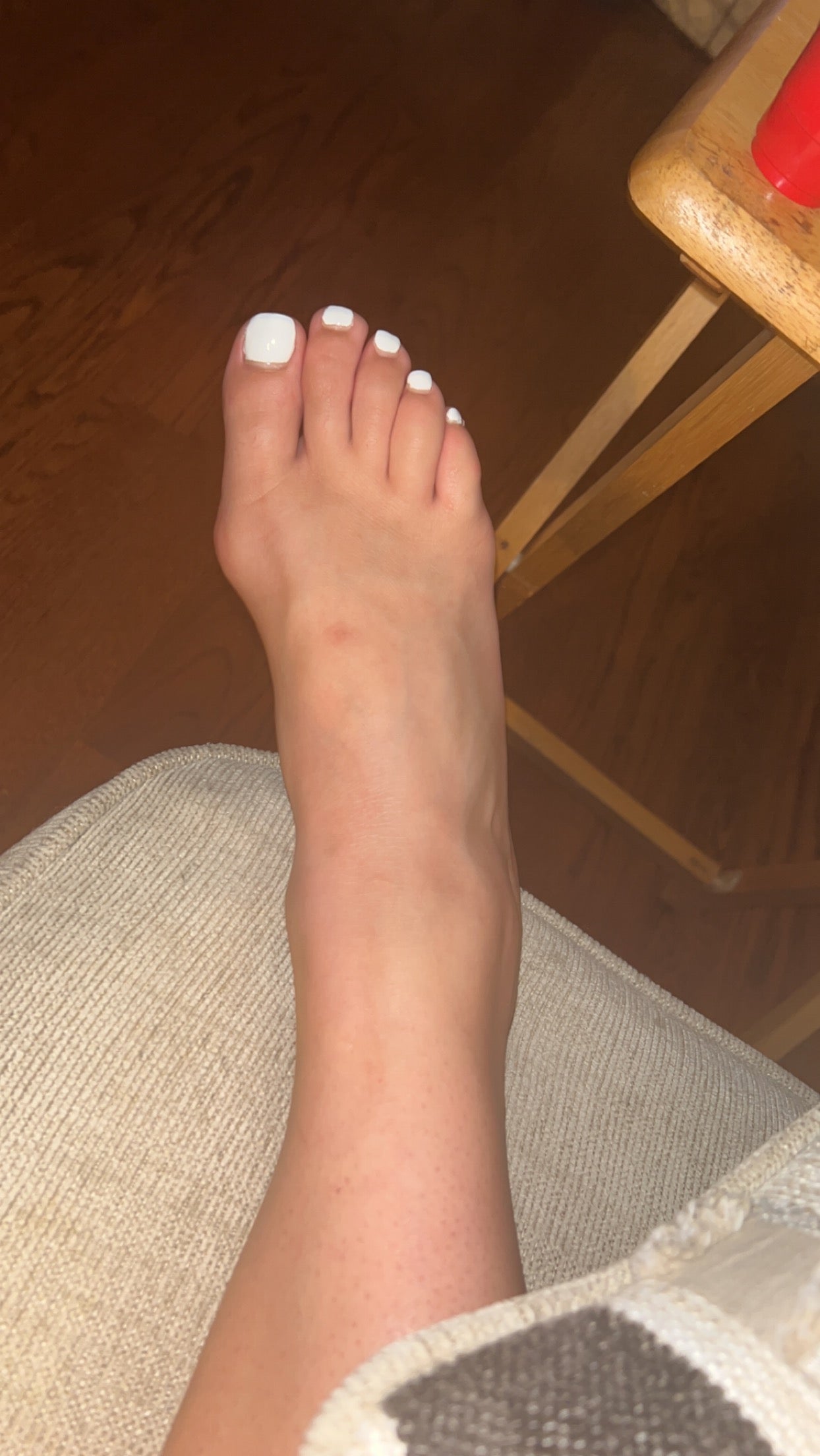 Bunions