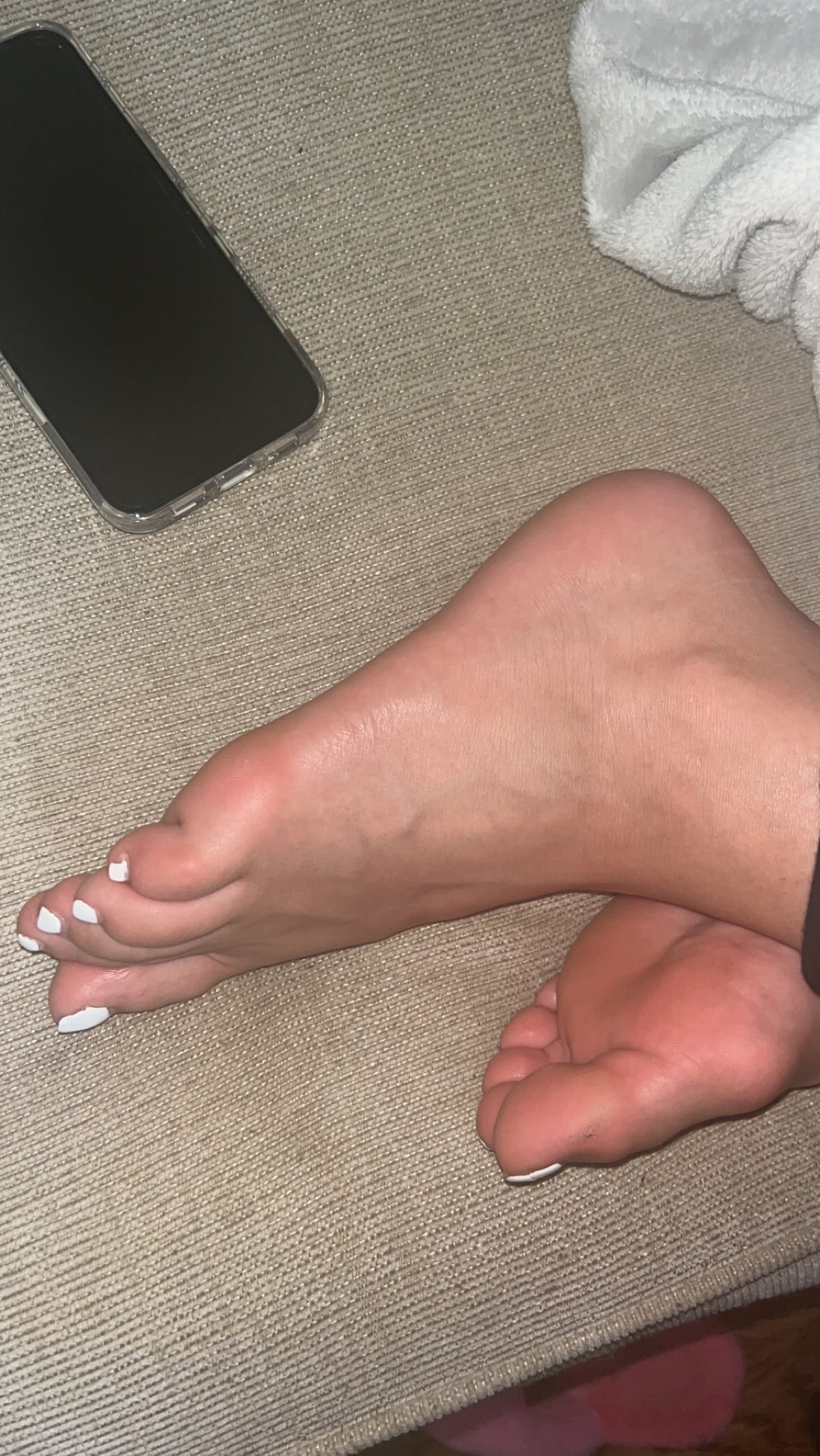 Bunions