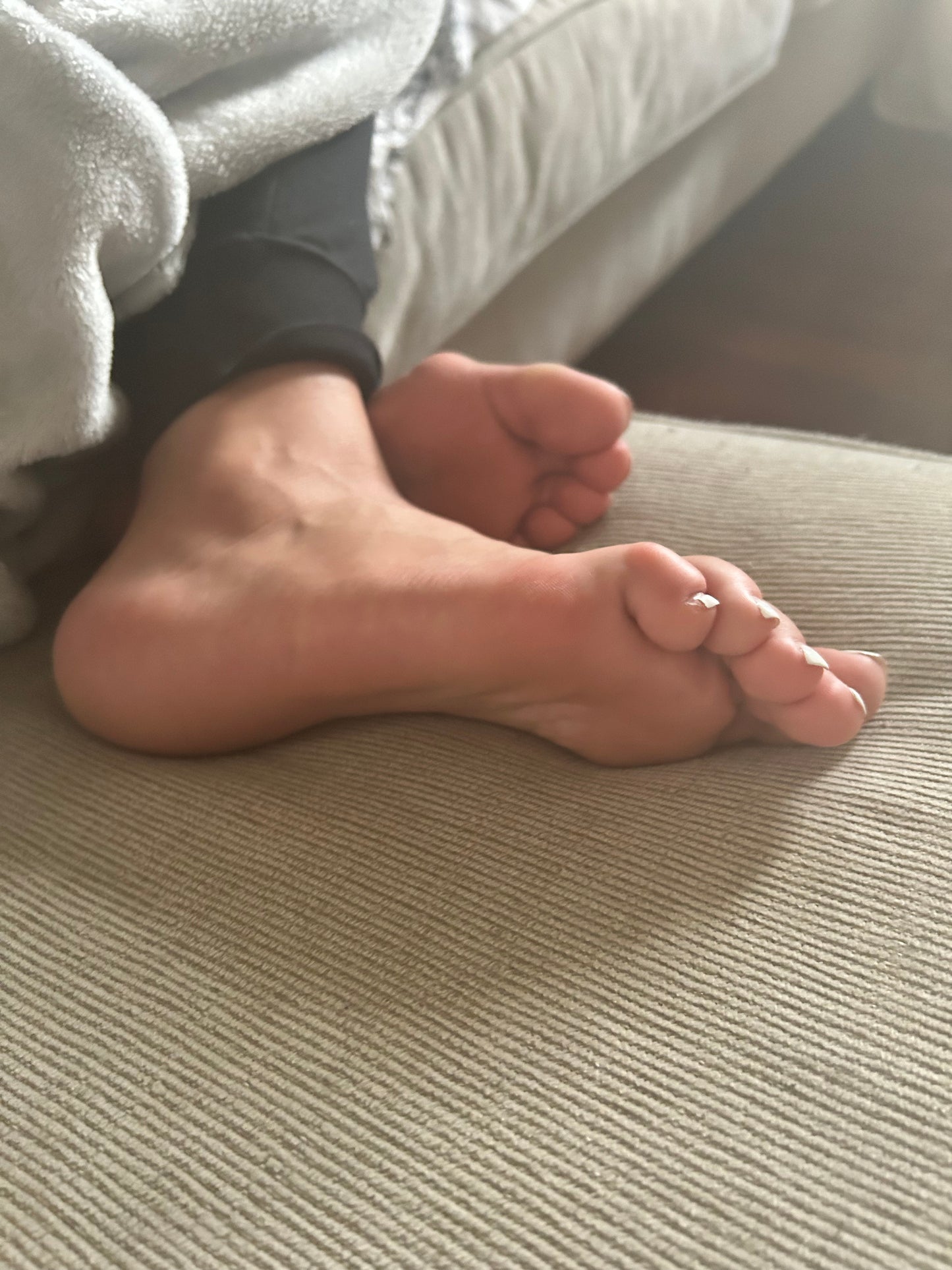 Bunions
