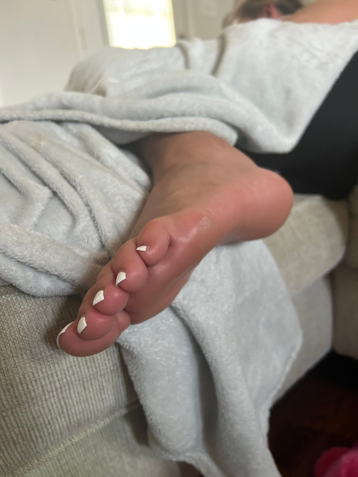 Bunions
