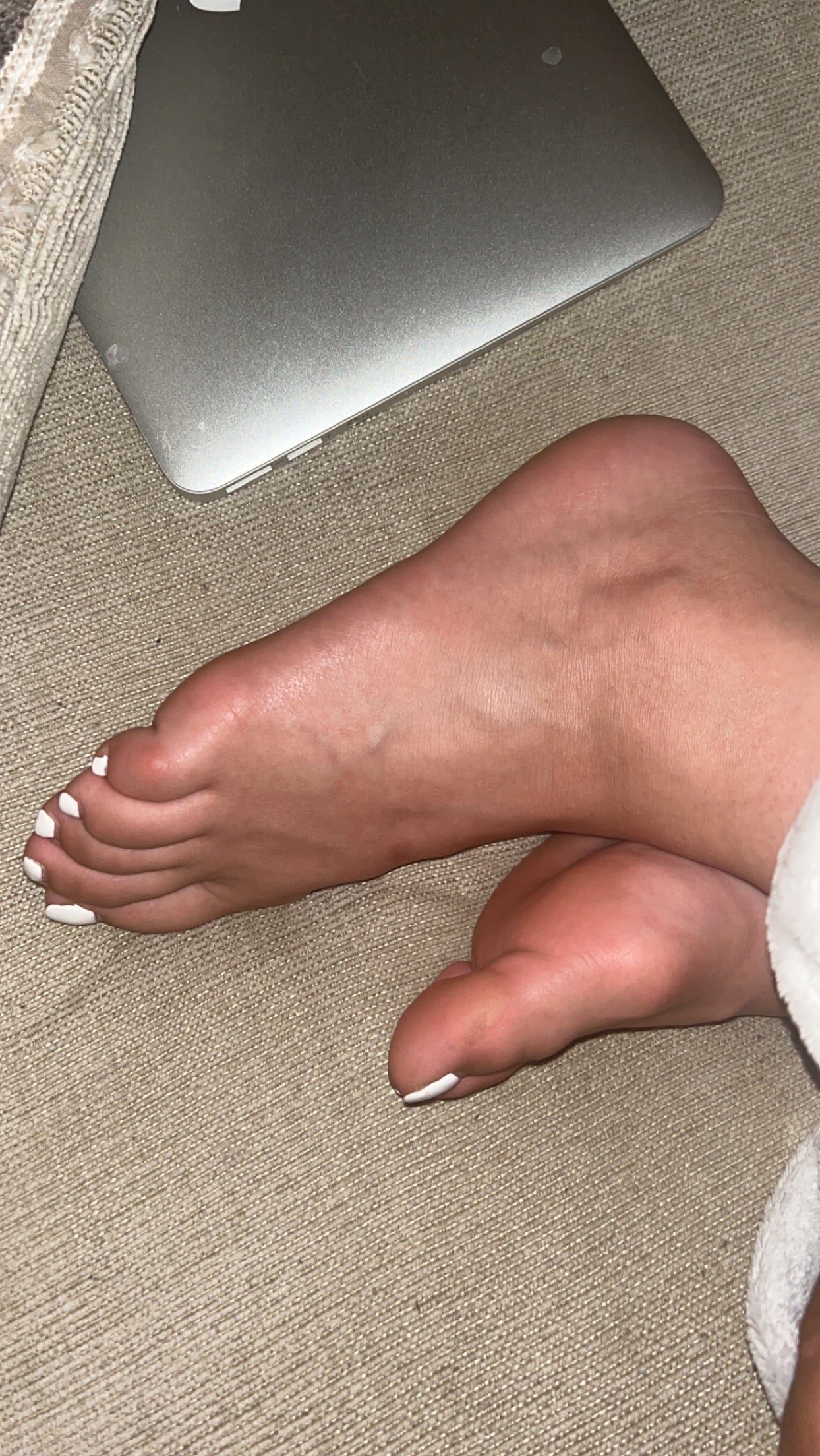 Bunions