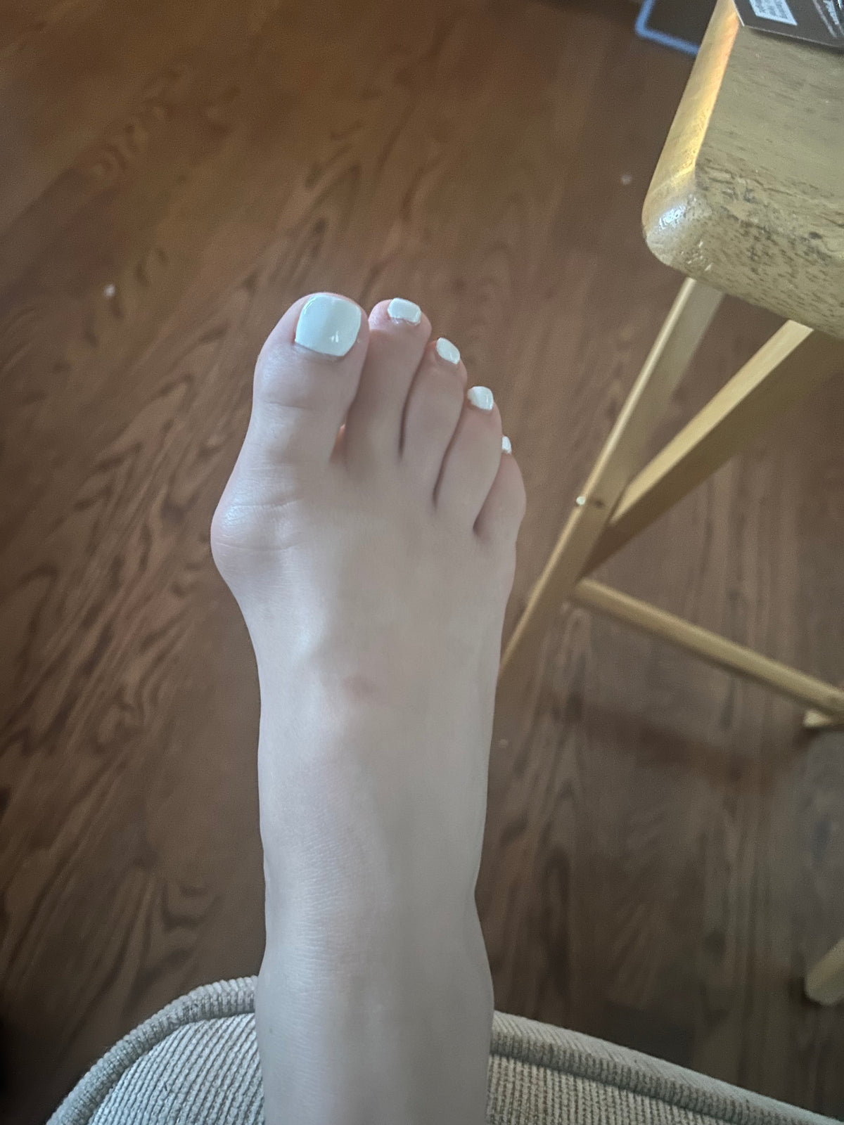 Bunions