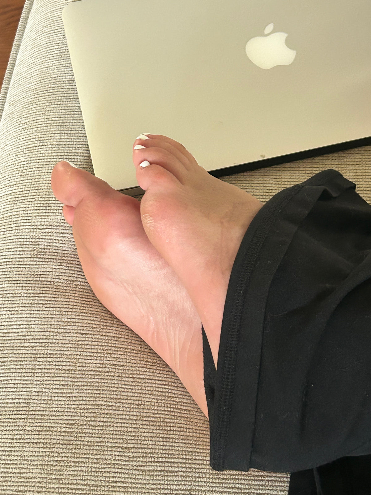Bunions