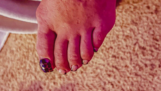 Bunions